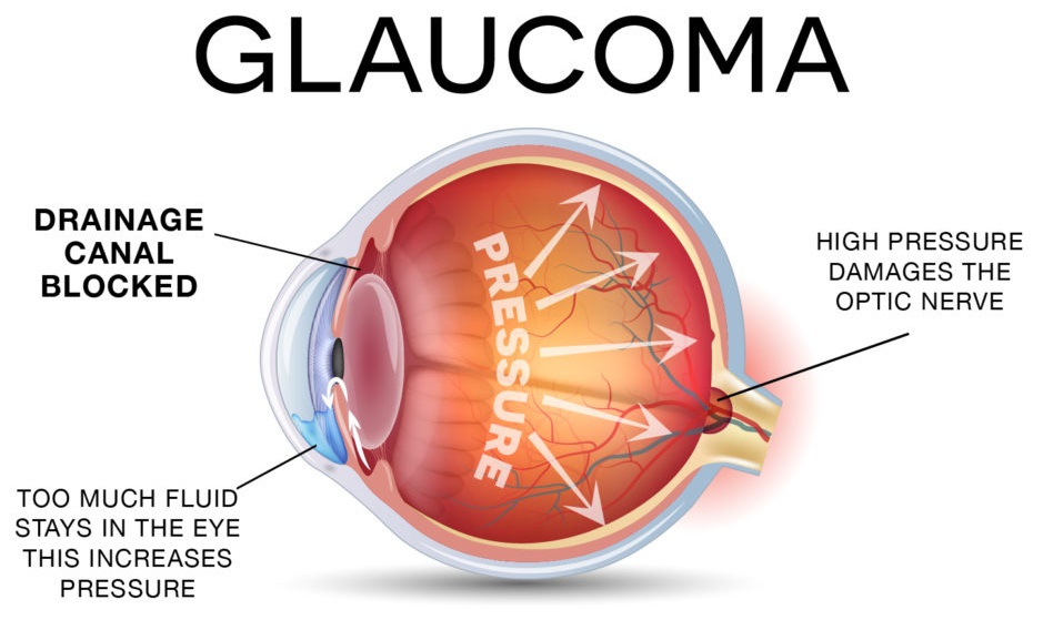 Glaucoma examination and treatment